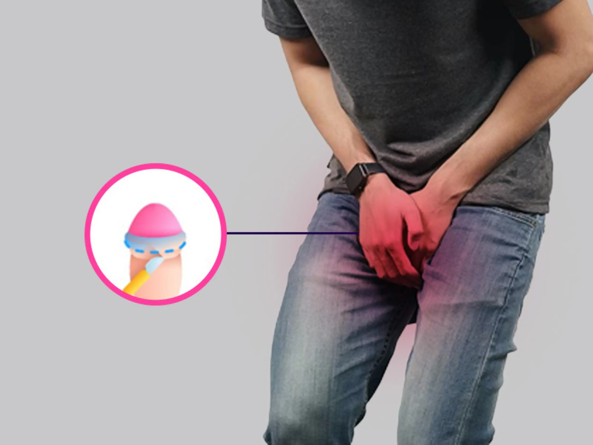 Circumcision Surgery